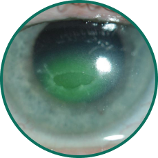 5 close-up eye images depicting 5 ocular conditions that may result in or be associated with persistent epithelial defects