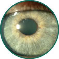5 close-up eye images depicting 5 ocular conditions that may result in or be associated with persistent epithelial defects