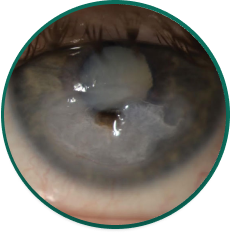 5 close-up eye images depicting 5 ocular conditions that may result in or be associated with persistent epithelial defects