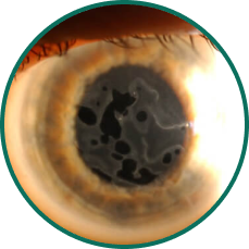 5 close-up eye images depicting 5 ocular conditions that may result in or be associated with persistent epithelial defects