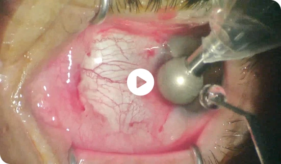 Close-up image of an eye during ocular surgery, with a metal surgical instrument and suction device applied to the exposed white scleral tissue.